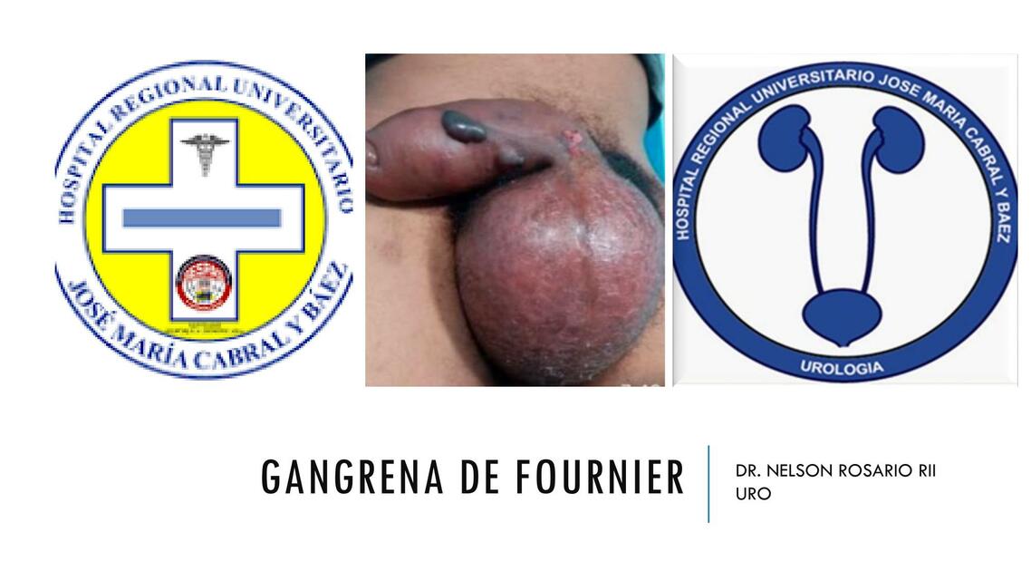 GANGRENA DE FOURNIER