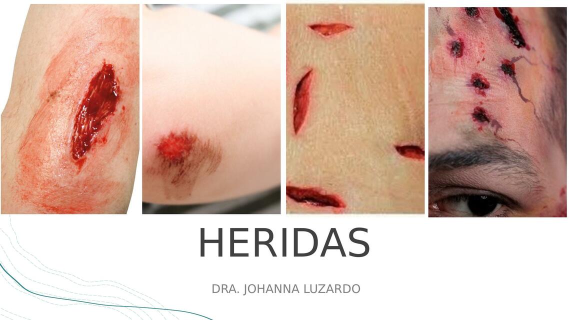 Heridas 