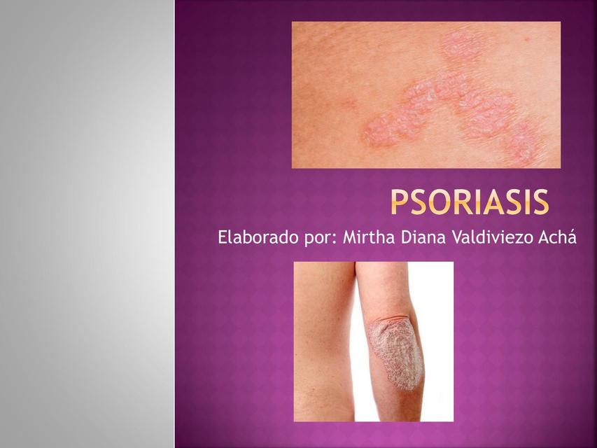psoriasis uDocz