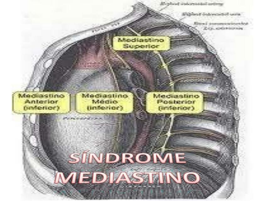 Mediastino loco