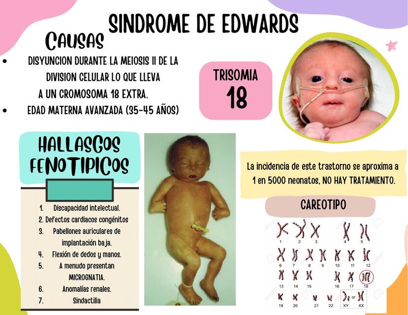 Síndrome de Edwards 