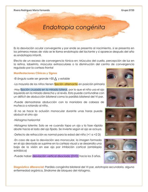 Endotropia Congénita | IOVANNY CRUZ OJEDA | uDocz