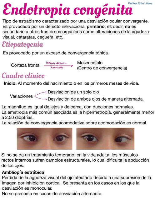 Endotropia Congénita | IOVANNY CRUZ OJEDA | uDocz