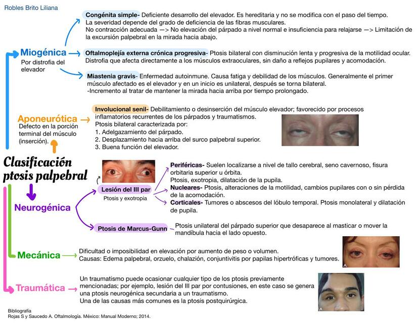 Clasificación de la ptosis palpebral | IOVANNY CRUZ OJEDA | uDocz