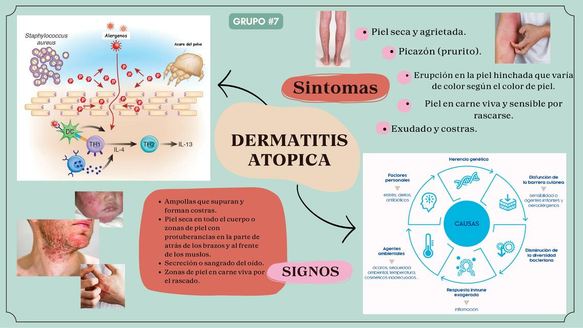 Dermatitis atopica 