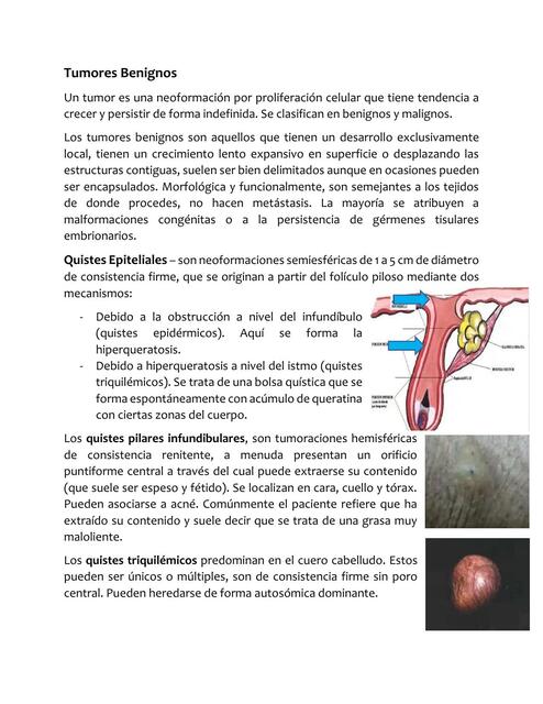 Tumores Benignos de la piel