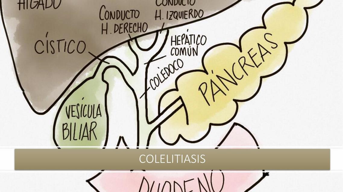 COLELITIASIS