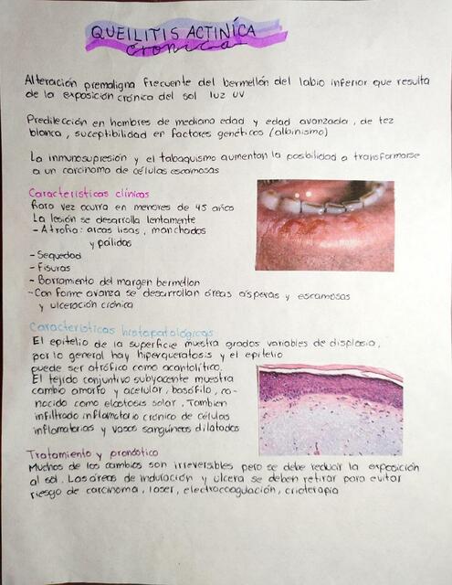 Queilitis actínica