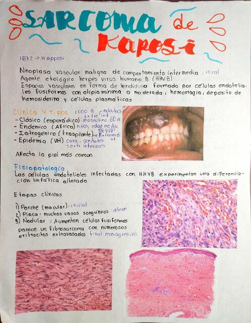 Sarcoma de Kaposi