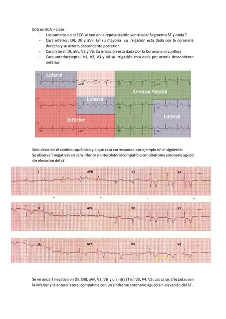 ECG en SCA Clase 