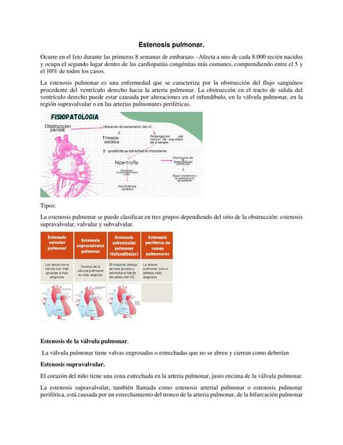 Estenosis pulmonar 