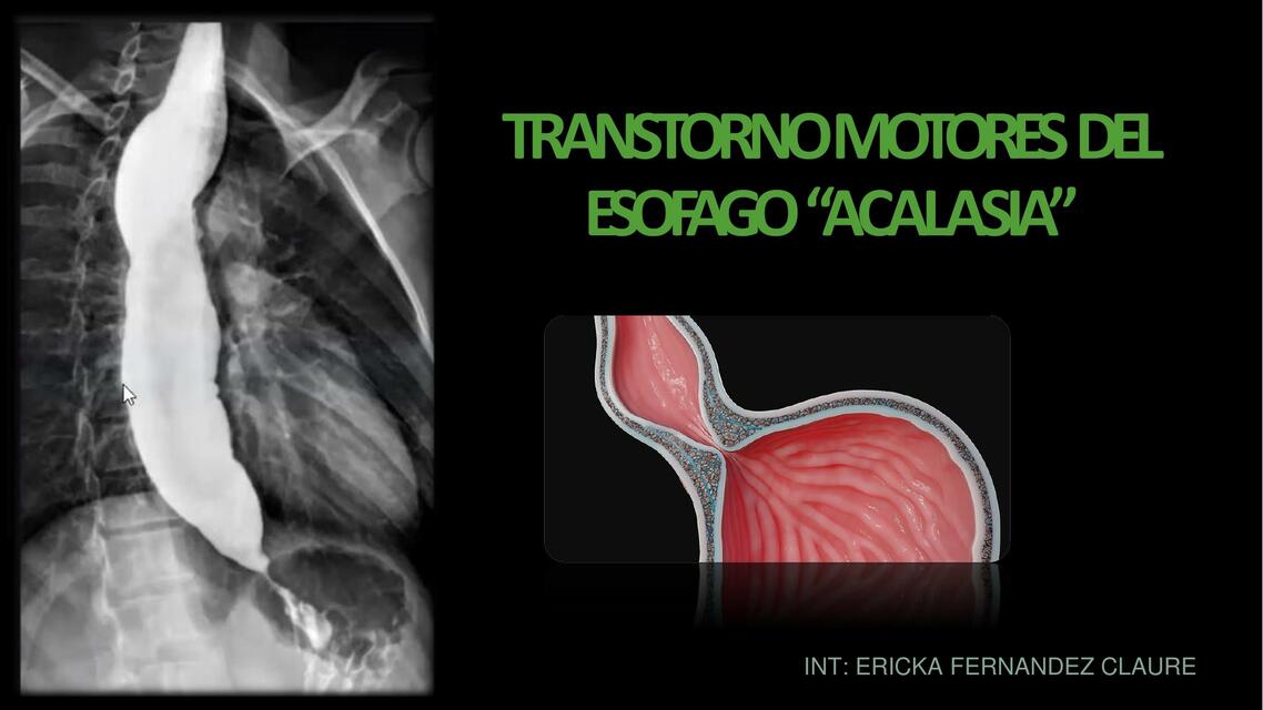 Trastorno Motor del Esófago "Acalasia"