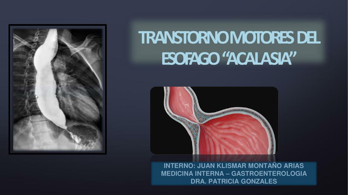 Acalasia 