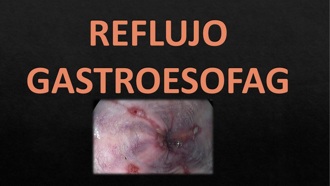 Reflujo Gastroesofágico 