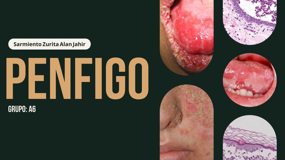 PENFIGO DERMATOLOGÍA UMSS