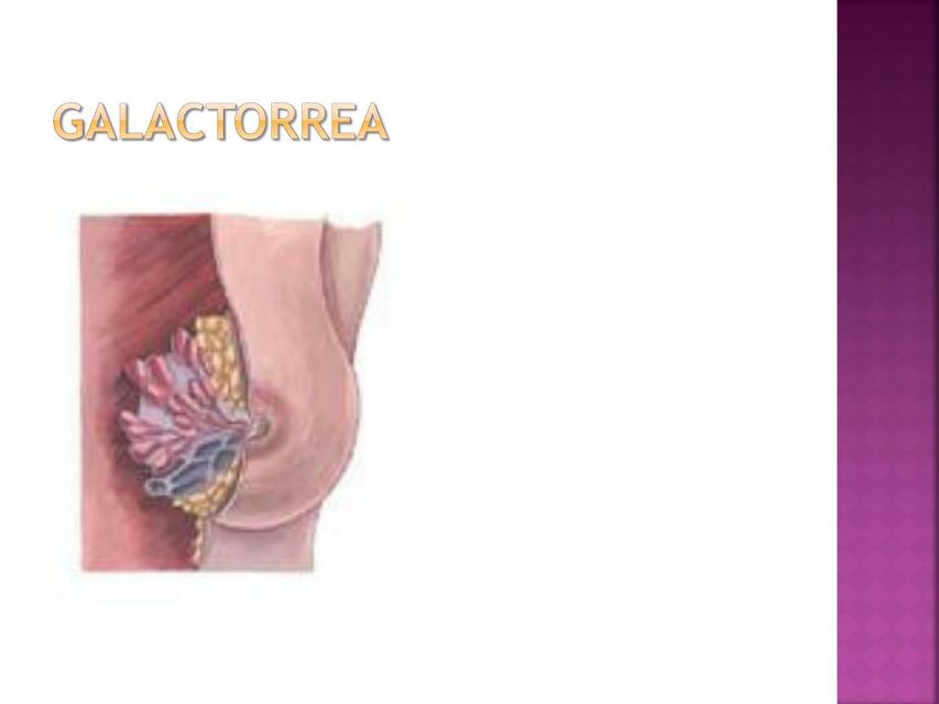 Galactorrea