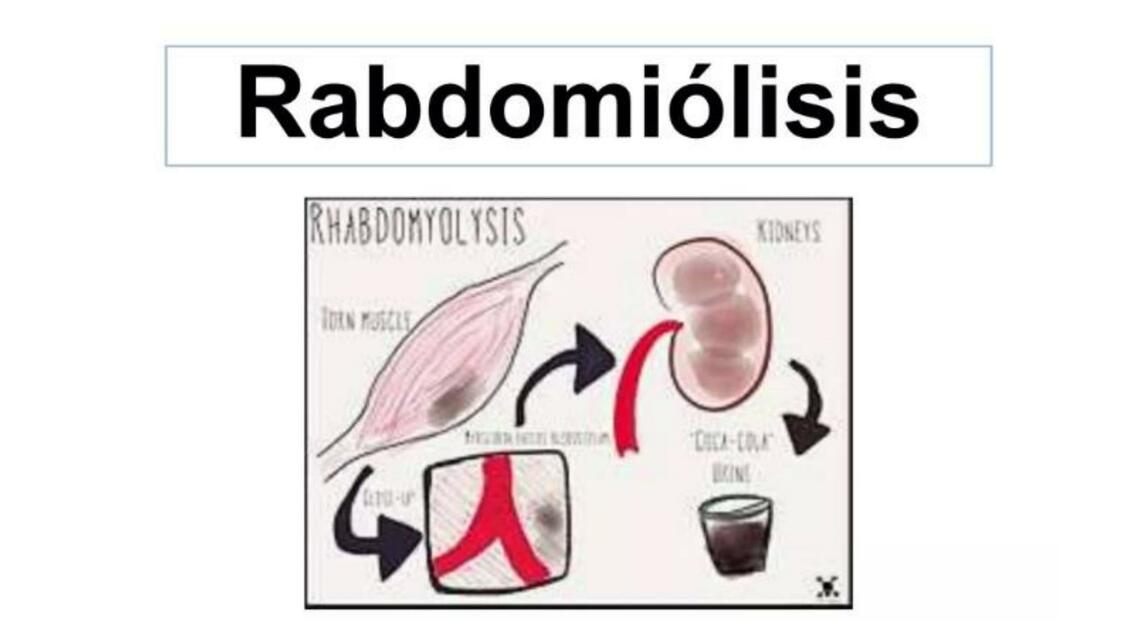 Rabdomiólisis 