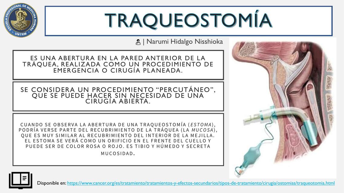 TRAQUEOSTOM A Dianaluz MT UDocz