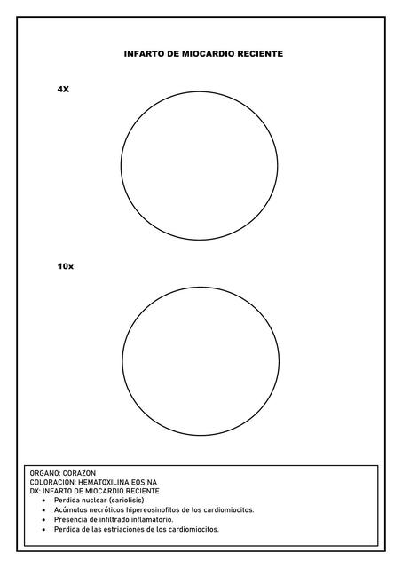 Infarto de Miocardio Reciente 