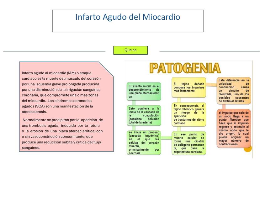 Infarto agudo del miocardio