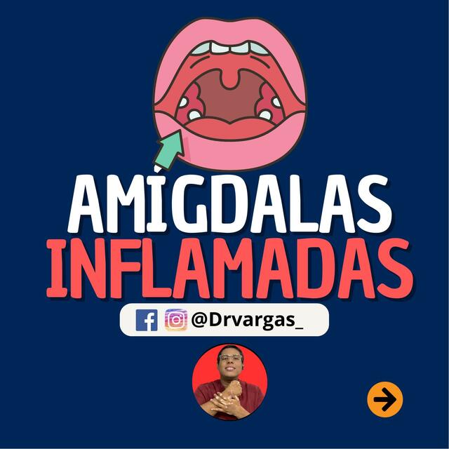 Amigdalitis