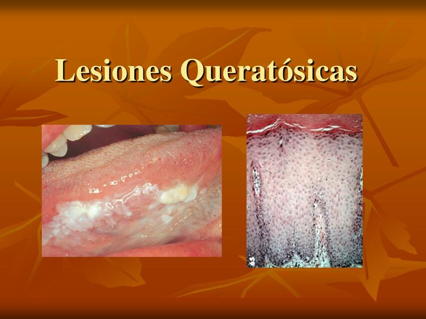 Lesiones Queratósicas 