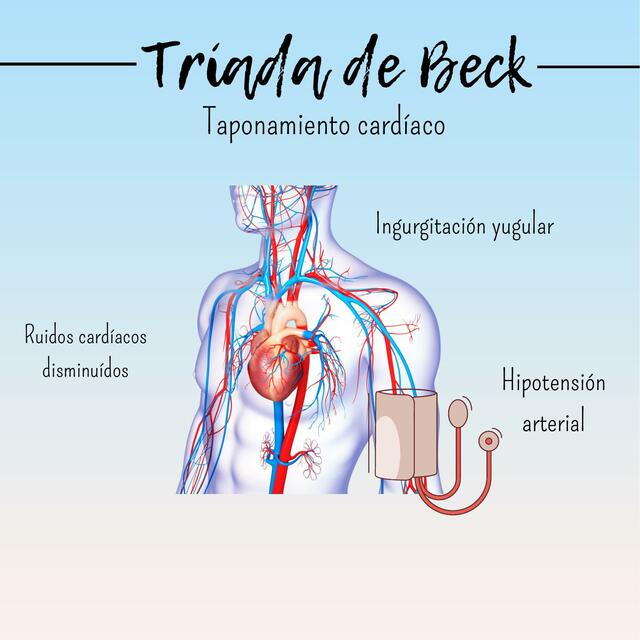 Tríada de Beck