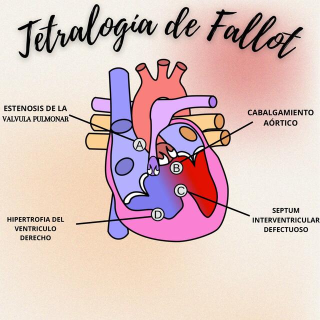 Tetralogía de Fallot