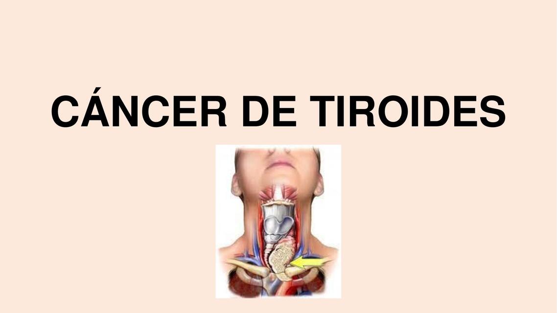 Cáncer de tiroides 