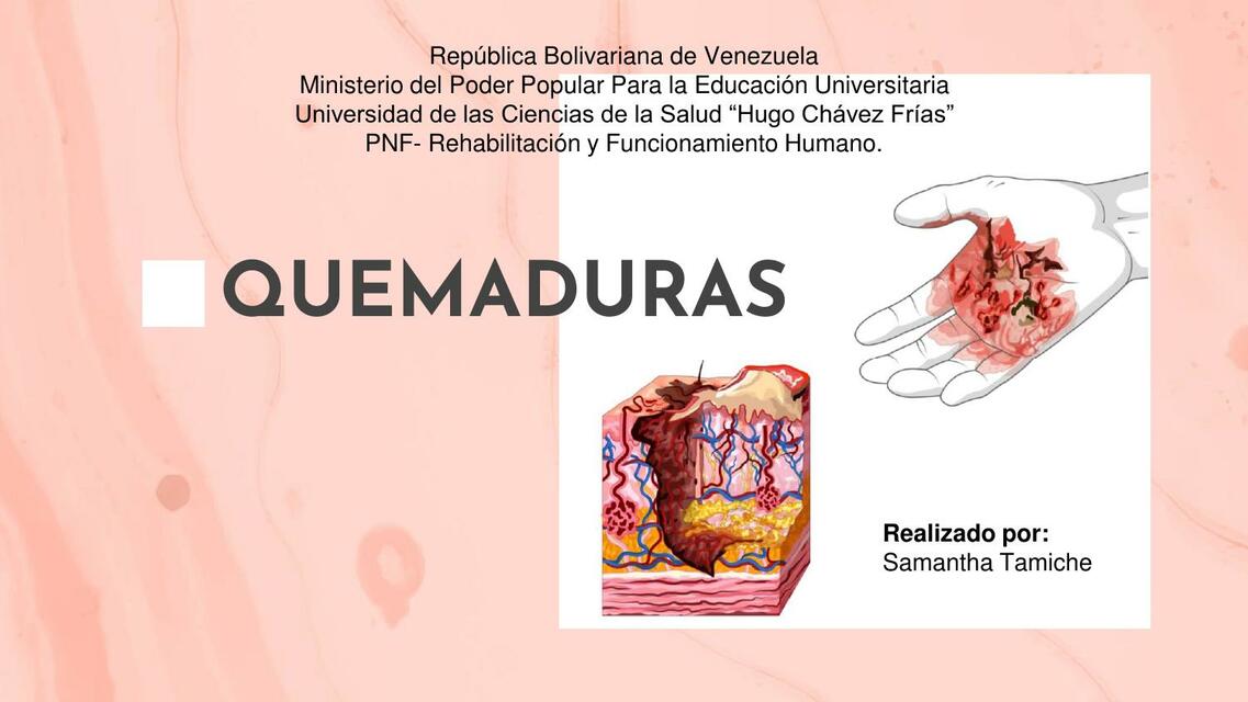 Quemaduras