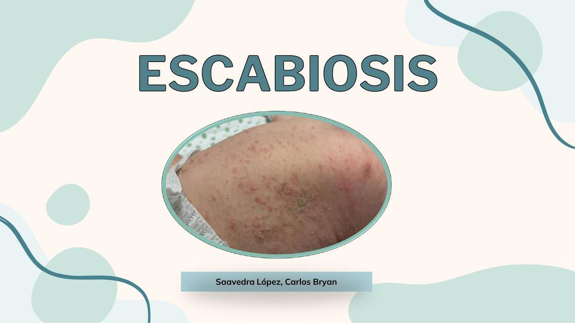 Escabiosis 