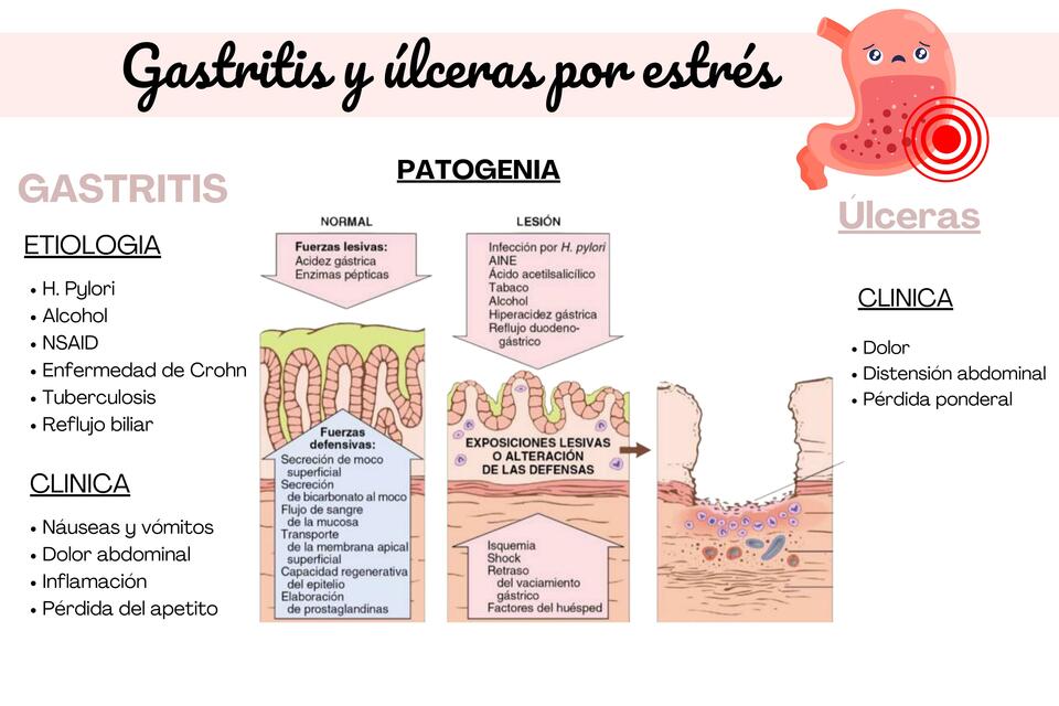 Gastritis y Úlceras por Estrés