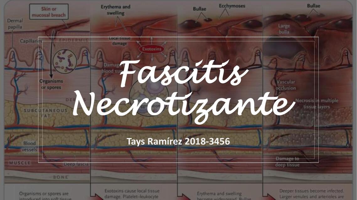 Fascitis Necrotizante  