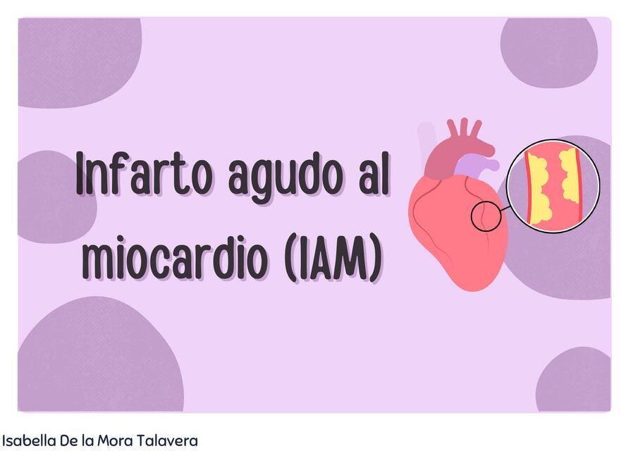 Infarto Agudo al Miocardio