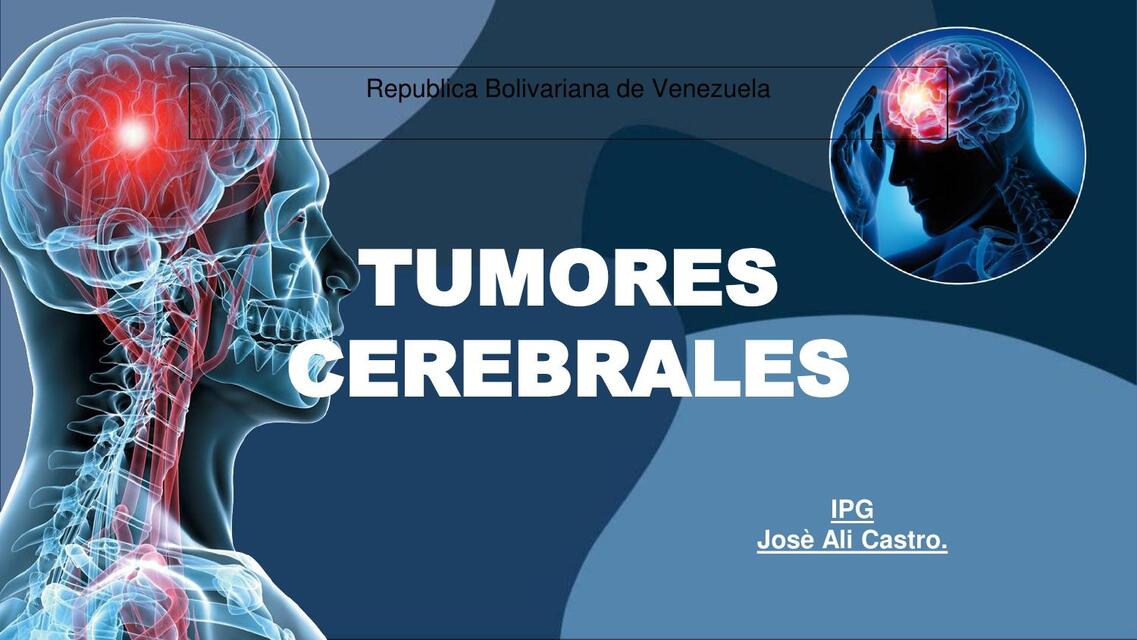 Tumores cerebrales  