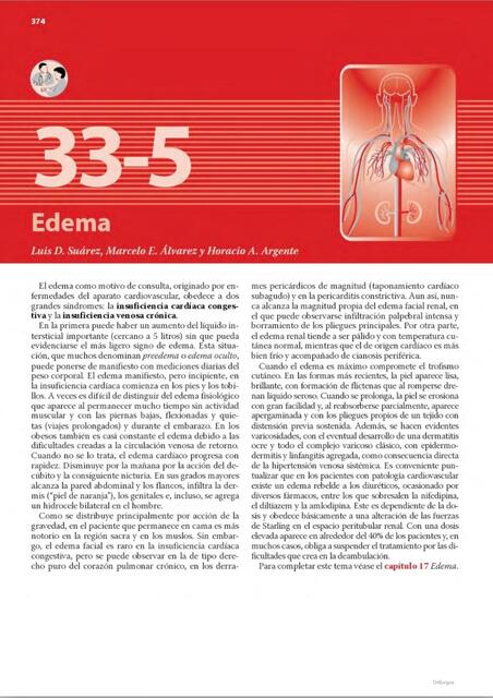 Edema 