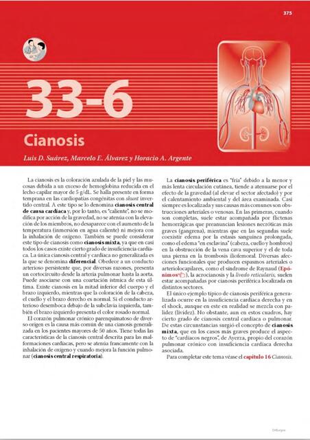 Cianosis 