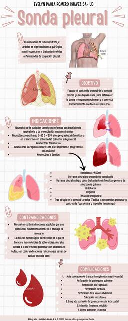 Sonda Pleural