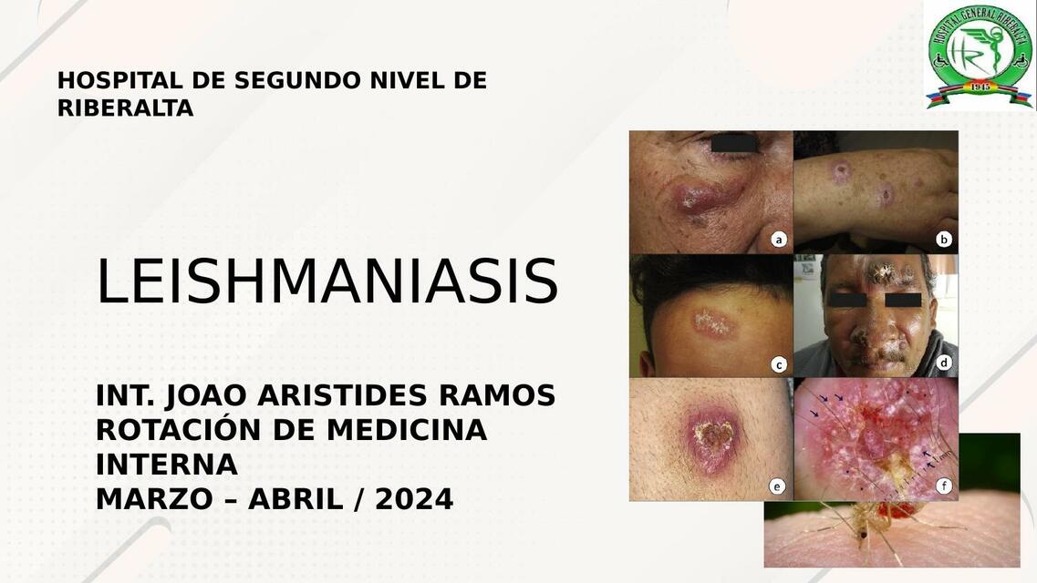 Leishmaniasis 