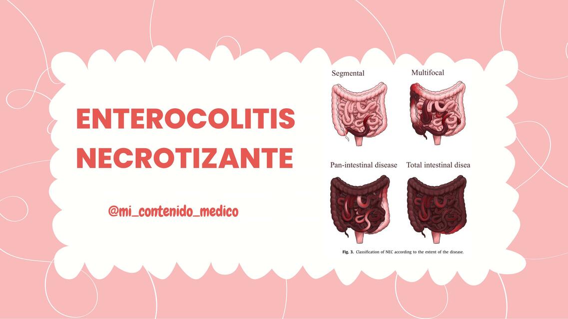 Enterocolitis necrotizante