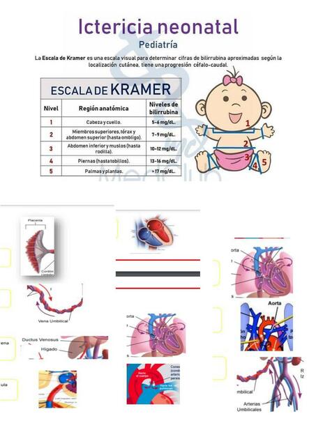 Ictericia Neonatal 