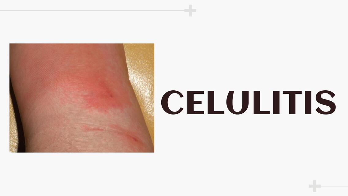 Celulitis 