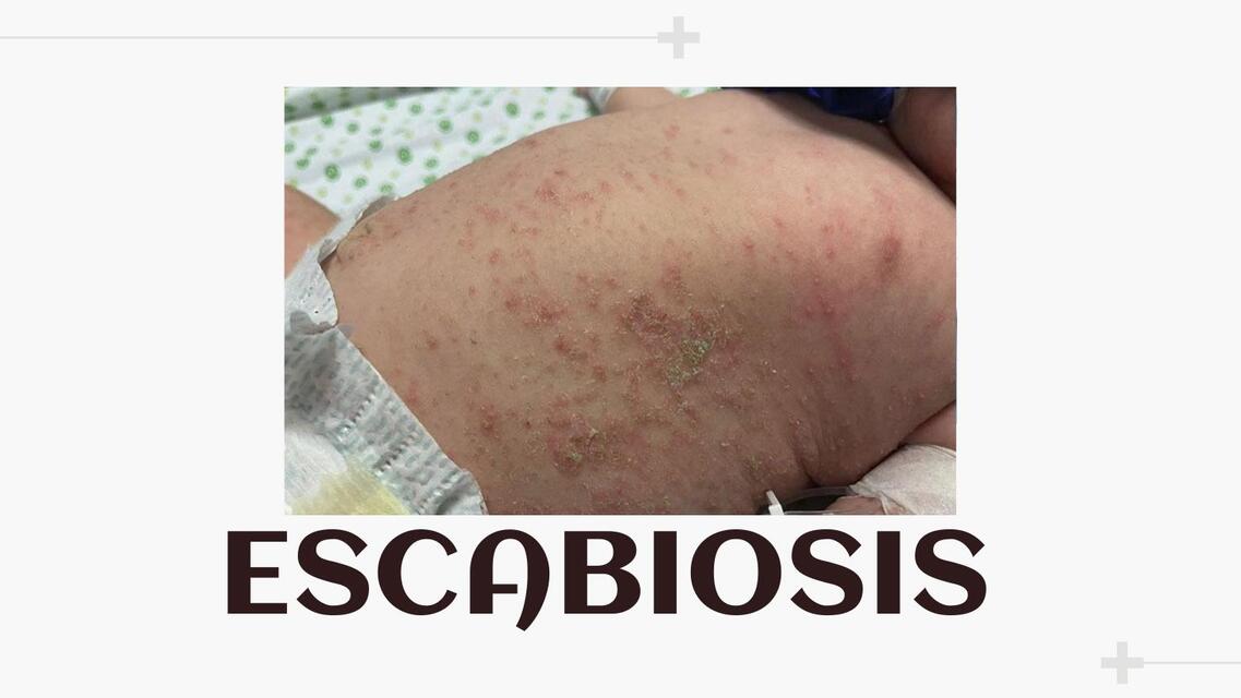 Escabiosis 