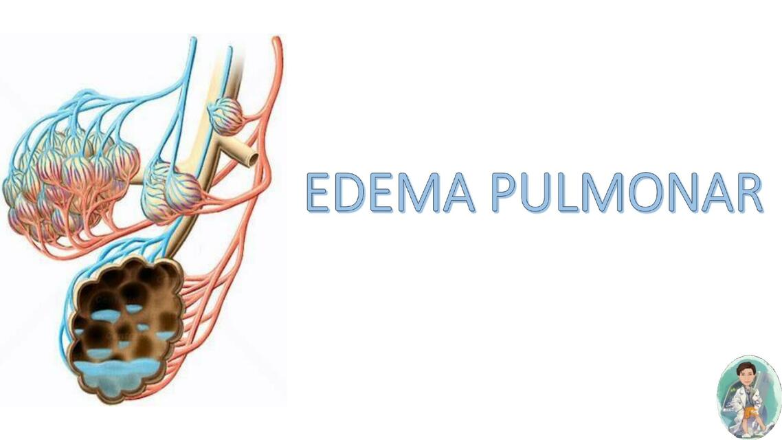 Edema Pulmonar 