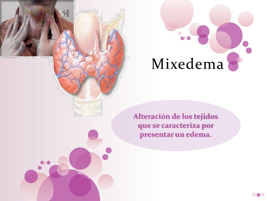 mixedema phpapp02 1