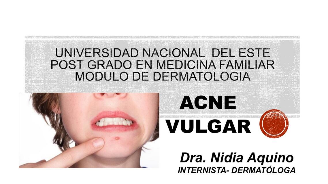 Acné Vulgar 