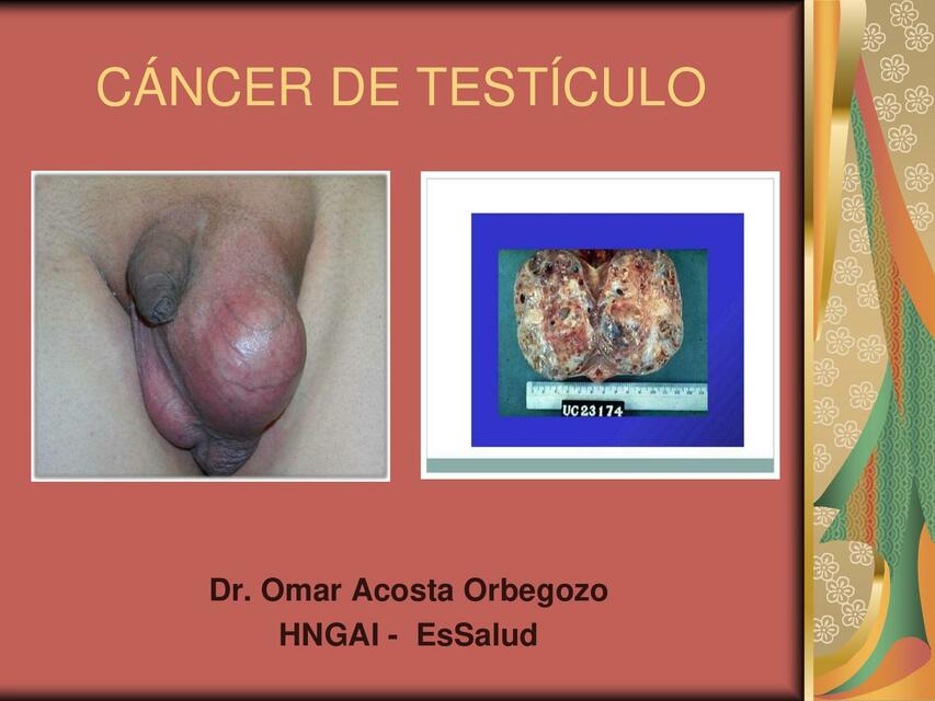 Clase 08 Cáncer de Testículo