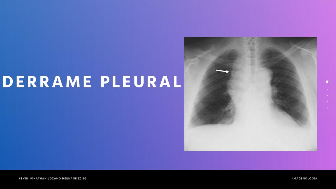 Derrame pleural