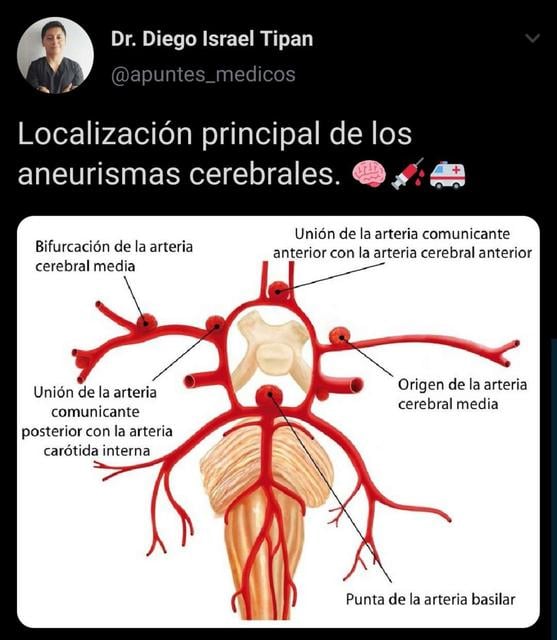 Aneurismas | Apuntes Médicos - Dr. Israel
