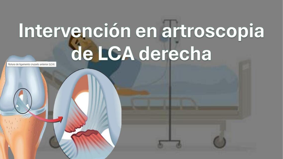 Post Lca Intervención kinésica Post Artroscopia de LCA derecha | Daly Andrea A ...